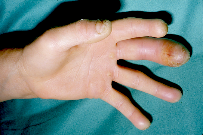 Felon Finger Infection Causes